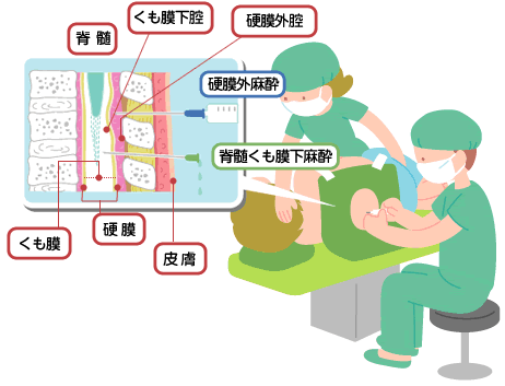 局所麻酔の2つの方法とその違いの図